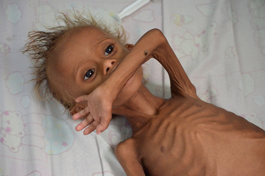 Κάθε 10 λεπτά πεθαίνει ένα παιδί - Συγκλονίζουν τα στοιχεία για την Υεμένη